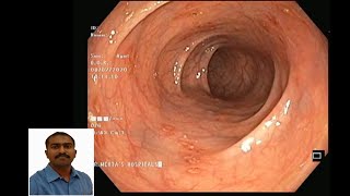 colonoscopyInflammatory bowel diseaseIBDUlcerative colitisEndoscopy biopsyDr Pandiaraja [upl. by Gasparo]