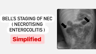 Bells Staging of NEC  Necrotising Enterocolitis  MisMedicine highyield [upl. by Ainej]