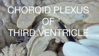 CHOROID PLEXUS OF THIRD VENTRICLE  An educational video [upl. by Ilocin]