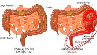 Hirschsprungs Disease [upl. by Loseff]