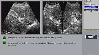 Liver Ultrasound Viral hepatitis in Arabic الالتهاب الكبدي الفيروسي [upl. by Luy]