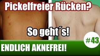 Pickel auf dem Rücken schnell loswerden Was tun Ursachen amp Lösungen ENDLICH AKNEFREI 43 [upl. by Halpern37]