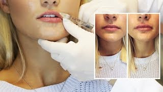 Lip Filler Experience  Start to Finish with 1 Syringe of Juvederm [upl. by Emera]