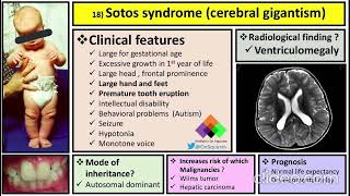 SOTOS SYNDROME  CLINICAL FEATURES  RISK  DIAGNOSIS AND MANAGEMENT [upl. by Tacye]