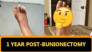 1 Year UPDATE  Post Bunionectomy Surgery  Any Regrets Will I Still Get Surgery on the Other Foot [upl. by Lenno]