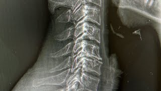 C5C6 Spondylosis with Neuropathic Tension from New Orleans  Louisiana Ring Dinger®️ [upl. by Ahlgren556]