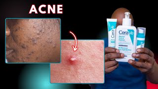 Cerave Essentials You Never Knew You Needed for Acne [upl. by Mathew46]