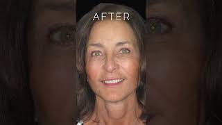 Amazing FACELIFT Before and After Results shorts faceliftsurgery [upl. by Haney]