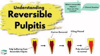 Reversible Pulpitis  Causes Diagnosis and Treatment  Endodontics [upl. by Shornick]