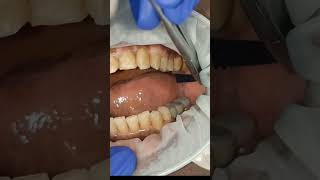 How to check 40 micron clearance for dental implant bridges  shorts [upl. by Phillis689]