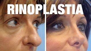 Rinoplastia Antes y Después  Tratamiento de Ana Isabel [upl. by Airotahs926]