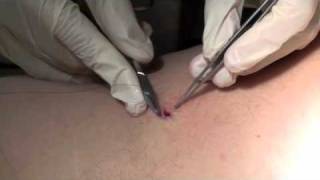 Learn about Skin Biopsies Punch Biopsy [upl. by Wellesley]