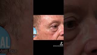 Rosacea treatment with LumeccaPL Sat Goodbye to redness and dark spots shorts lumeccaipl [upl. by Rebm]