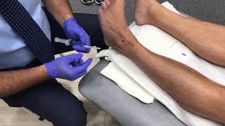 Ankle Steroid injection [upl. by Rocca]