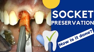 Tooth extraction and SOCKET PRESERVATION  How is it done [upl. by Lesak]