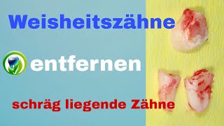 Weisheitszähne Weisheitszahn entfernen Osteotomie Zahn teilen verlagert retiniert [upl. by Ekralc69]