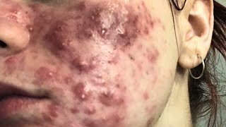 cystic acne blackhead whitehead removal  Relaxing Spa Acne Treatment [upl. by Farrell]