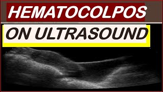 Hematocolpos on ultrasound [upl. by Lux]