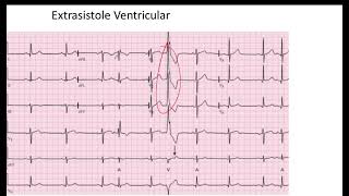 Comparación Extrasistole Auricular vs Ventricular EKG [upl. by Vinni886]