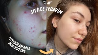 ROACCUTANE  ZORETANİN TEDAVİ SÜRECİM  SİVİLCE TEDAVİSİ NASIL HİÇ LEKEM YOK [upl. by Akeme]