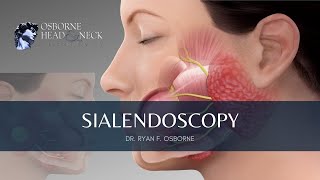 Sialendoscopy Procedure for Parotid Gland Stones Explained By Dr Ryan F Osborne [upl. by Lynette]