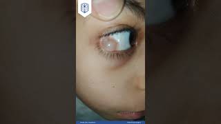 Educational Video 22 Conjunctival cyst by AEA [upl. by Natsirc]