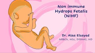 Non Immune Hydrops Fetalis NIHF TOG 2023 [upl. by Gati283]