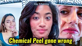 INFLUENCERS NEED TO STOP PROMITING CHEMICAL PEEL AS BEAUTY TREATMENT [upl. by Enyalaj]