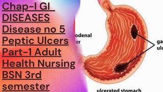 Adult Health Nursing BSN 3rd semester chap 1 GIDiseases Disease No 5 Peptic Ulcers part 1 [upl. by Asyral]