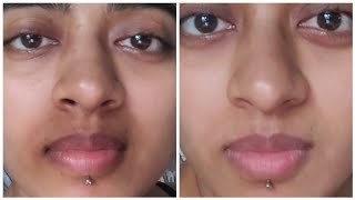 How I ACTUALLY got Rid of Pigmentation Around my Mouth  Pigmentation Treatment For Mouth Darkness [upl. by Idona]