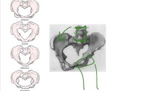 33 contracted pelvis [upl. by Anairol]