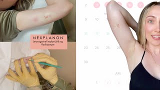 Healing After Nexplanon Birth Control Implant Removal [upl. by Puritan]