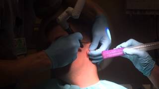 Keloid Laser Removal [upl. by Enautna]