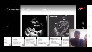 Pericardial disease Basic session 1 [upl. by Carny893]