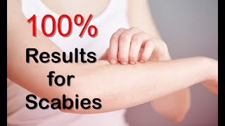 How To Get Rid Of Scabies With Natural Remedies And Scabies Treatment [upl. by Livingstone92]