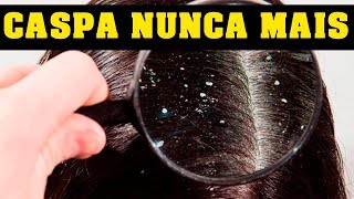 COMO ACABAR COM A CASPA Dermatite seborreica [upl. by Yhprum]