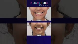 Before and After Aligners Treatment In Hyderabad  Invisible Aligners Journey  Clear Aligners [upl. by Neelat]