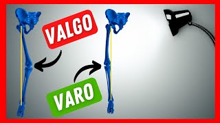 Ginocchio VARO e ginocchio VALGO  significato ed implicazioni 👈 [upl. by Coop]