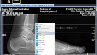 Orthopedic Measurements using iQVIEW 28 Calcaneus Inclination Angle [upl. by Eixel72]