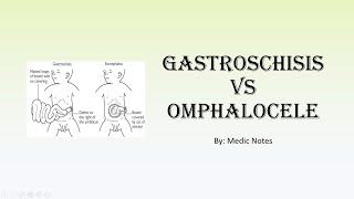 Gastroschisis vs omphalocele [upl. by Giorgia]