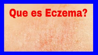 Que es Eczema  Eczema Definicion [upl. by Krahmer]