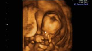 Ecografia 16 semanas 4D y 2D Ultrasound Irati [upl. by Attenborough26]