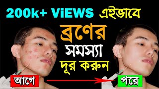 ব্রণ দূর করার উপায়  Mukher kalo dag dur korar upay  How to Remove Pimples or Acne [upl. by Ennej]