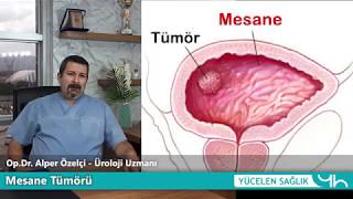 Mesane Tümörü  OpDr Alper Özelçi  Üroloji Uzmanı [upl. by Huttan]