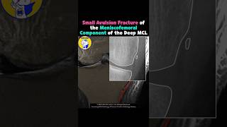 Fig 3A22 Avulsion fracture of meniscofemoral ligament [upl. by Hafirahs]