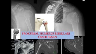 Proksimal Humerus Kırıkları  Proximal Humerus Fractures [upl. by Akiret527]