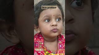 Skin problem shortsfeed shorts youtubeshorts like baby minivlog tedibar [upl. by Abehs302]