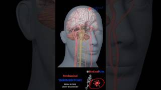 How Mechanical Thrombectomy Saves Stroke Patients Shorts [upl. by Siana729]