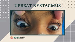 nystagmus  eye movements l demo on a patient l horizontal amp vertical nystagmus neurology [upl. by Anerrol]