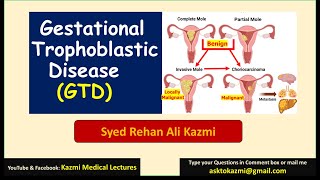 Gestational Trophoblastic Disease  Molar pregnancy  Obstetric review  KML [upl. by Luemas808]